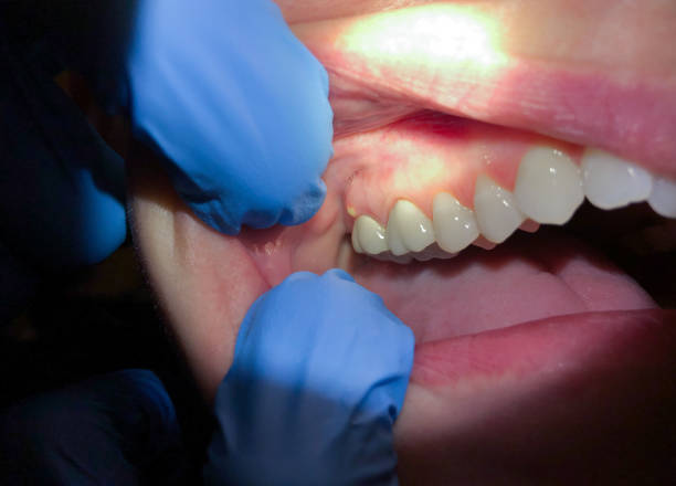 Best Urgent Dental Care for Toothache in Lewisburg, PA